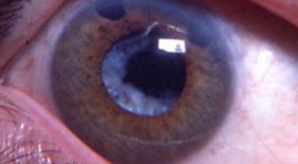 фото глаза со вторичной катарактой